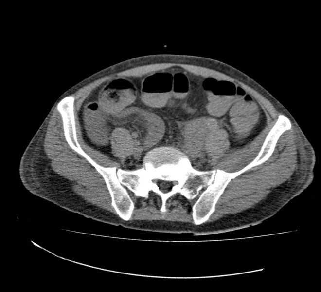 File:Bowel lymphoma complicated by bleeding after therapy (Radiopaedia 55601-62110 Axial non-contrast 61).jpg