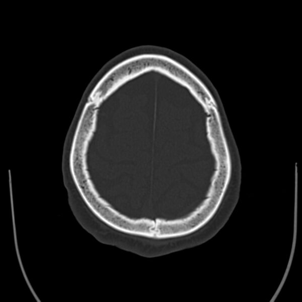 File:Brain Pantopaque remnants (Radiopaedia 78403-91048 Axial bone window 57).jpg