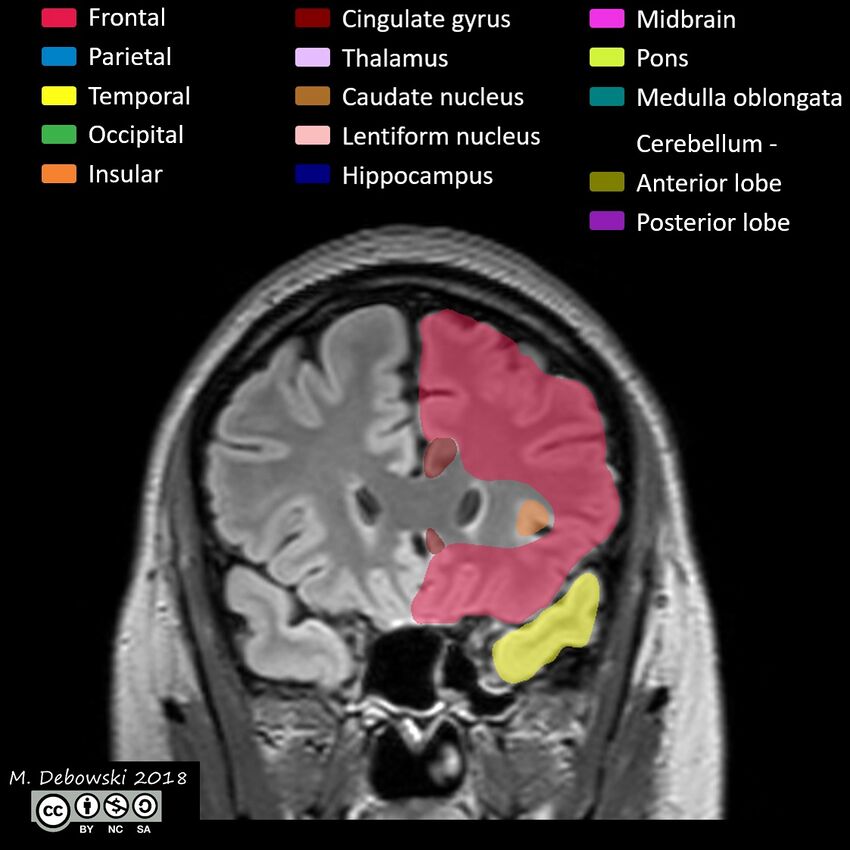 Brain lobes - annotated MRI (Radiopaedia 61691-69700 Coronal 20).JPG