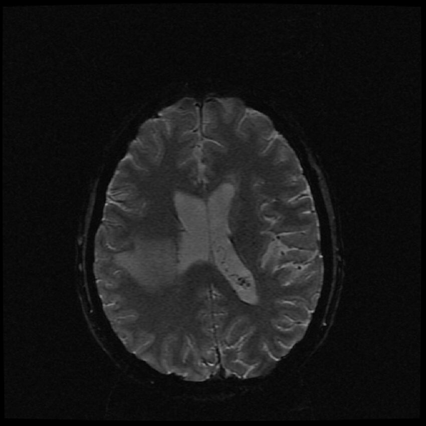 Brain metastases (renal cell carcinoma) (Radiopaedia 42571-45704 Axial SWI 22).jpg
