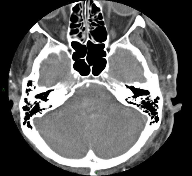 File:Brainstem hemorrhage (Radiopaedia 58794-66028 D 46).jpg