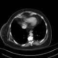 Breast carcinoma with pathological hip fracture (Radiopaedia 60314-67974 B 5).jpg