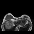 Breast implants - MRI (Radiopaedia 26864-27035 Axial T1 12).jpg