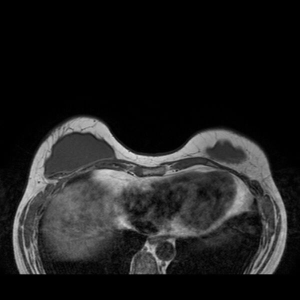 File:Breast implants - MRI (Radiopaedia 26864-27035 Axial T1 12).jpg
