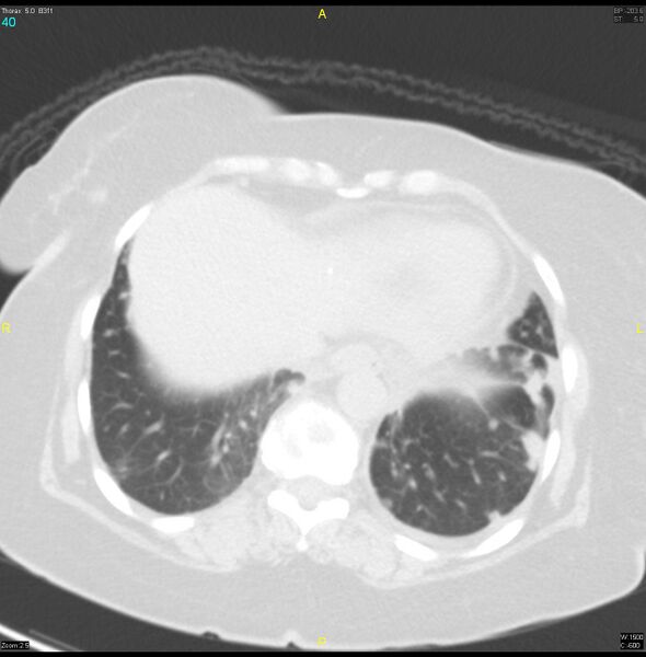 File:Breast primary with lung and bone metastases (Radiopaedia 40620-43228 Axial lung window 40).jpg
