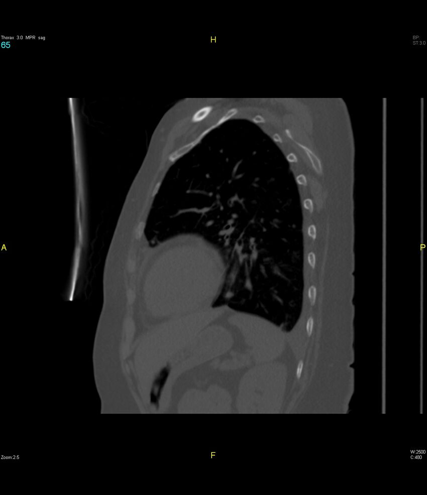 Breast primary with lung and bone metastases (Radiopaedia 40620-43228 Sagittal bone window 65).jpg