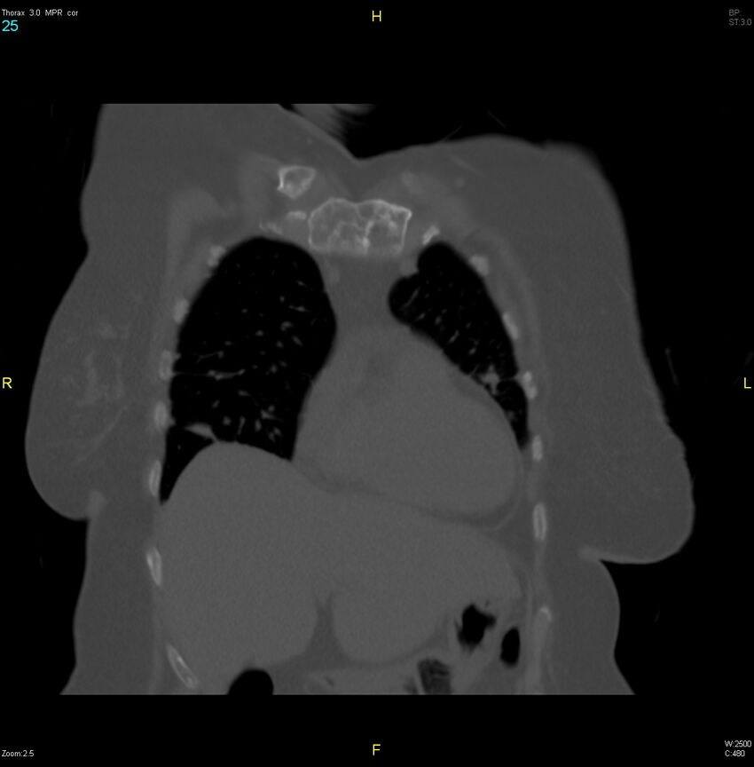 Breast primary with lung and bone metastases (Radiopaedia 40620-43228 bone window 25).jpg