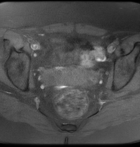 File:Broad ligament leiomyoma (Radiopaedia 81634-95516 Axial T1 fat sat 15).jpg