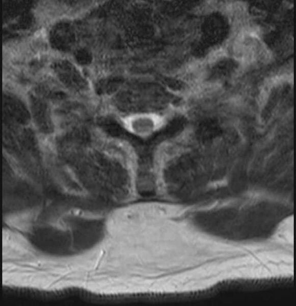 File:Brown tumors compressing the spinal cord (Radiopaedia 68442-78030 A 55).jpg