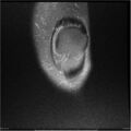 Bucket handle tear - lateral meniscus (Radiopaedia 7246-8187 Coronal T2 fat sat 20).jpg