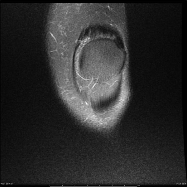 File:Bucket handle tear - lateral meniscus (Radiopaedia 7246-8187 Coronal T2 fat sat 20).jpg