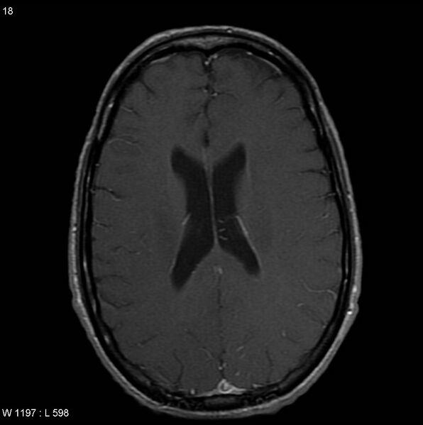 File:CMV ventriculitis and encephalitis (Radiopaedia 5416-7166 Axial T1 C+ 7).jpg