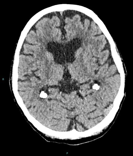 File:Calcified cerebral emboli from left ventricular thrombus (Radiopaedia 84420-99758 Axial non-contrast 51).jpg