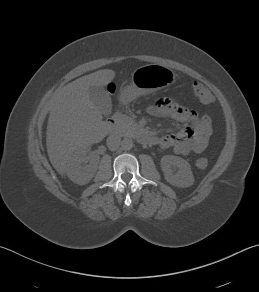 File:Calcified hepatic hydatid cyst (Radiopaedia 81127-94738 Axial non-contrast 42).jpg