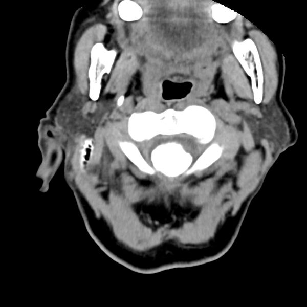 File:Calcified meningioma - cervical canal (Radiopaedia 70136-80171 B 6).jpg