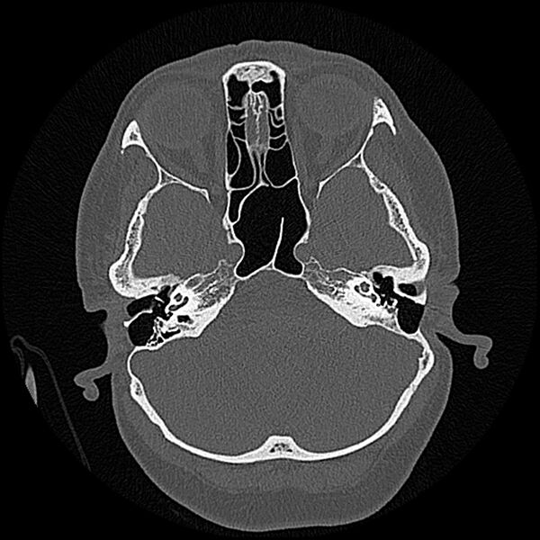 File:Canal up mastoidectomy (Radiopaedia 78108-90638 Axial bone window 69).jpg