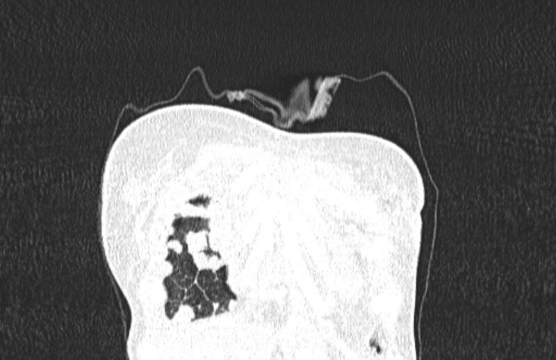 File:Cannonball metastases from breast cancer (Radiopaedia 91024-108569 Coronal lung window 12).jpg