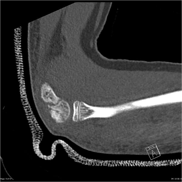 File:Capitellum fracture (Radiopaedia 23352-23426 Sagittal bone window 9).jpg