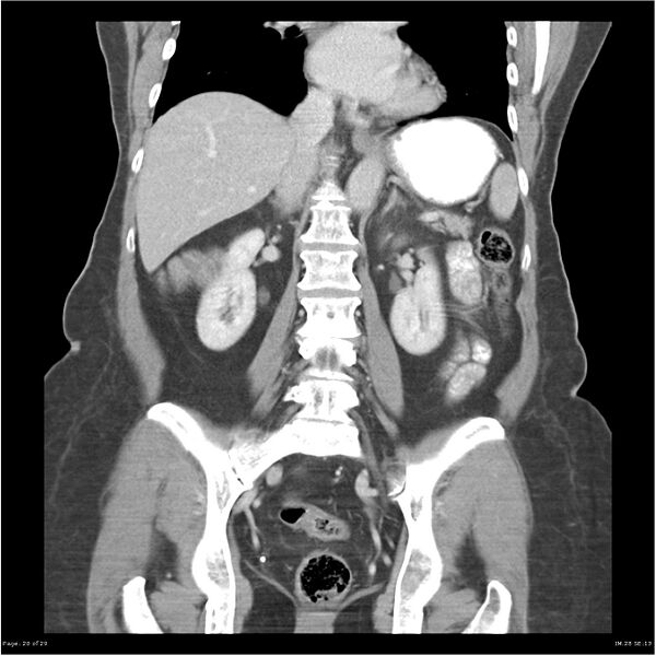 File:Carcinoid tumor of the ileum with metastasis to orbit (Radiopaedia 28165-28425 B 20).jpg