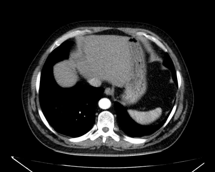 Carcinoid tumor with hepatic metastases (Radiopaedia 22651-22670 B 10).jpg