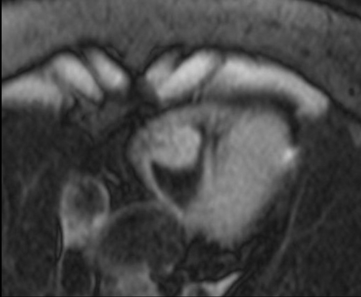 File:Cardiac hemangioma (Radiopaedia 31709-32631 Horizontal long axis 2).png