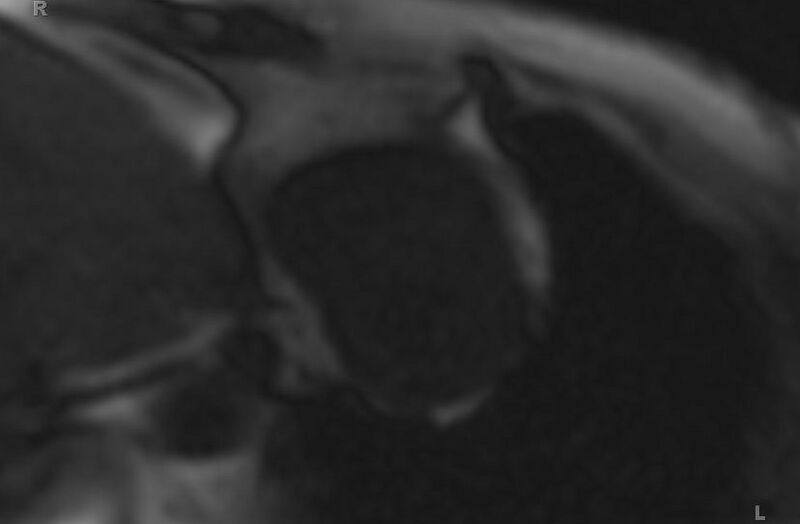 File:Cardiac hemangioma (Radiopaedia 31709-32631 Short axis 107).jpg