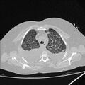 Cardiogenic pulmonary edema (Radiopaedia 29213-29609 Axial lung window 16).jpg