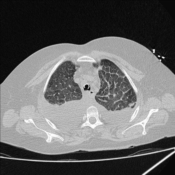 File:Cardiogenic pulmonary edema (Radiopaedia 29213-29609 Axial lung window 16).jpg