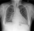 Cardiogenic pulmonary edema grade 1 (Radiopaedia 85524-101228 Frontal 1).jpg