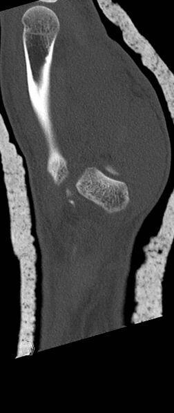 File:Carpal fractures (smart watch impaction) (Radiopaedia 55844-62430 Sagittal bone window 36).jpg