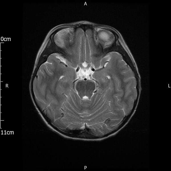 File:Cavernous sinus thrombosis (Radiopaedia 79414-92512 Axial T2 11).jpg