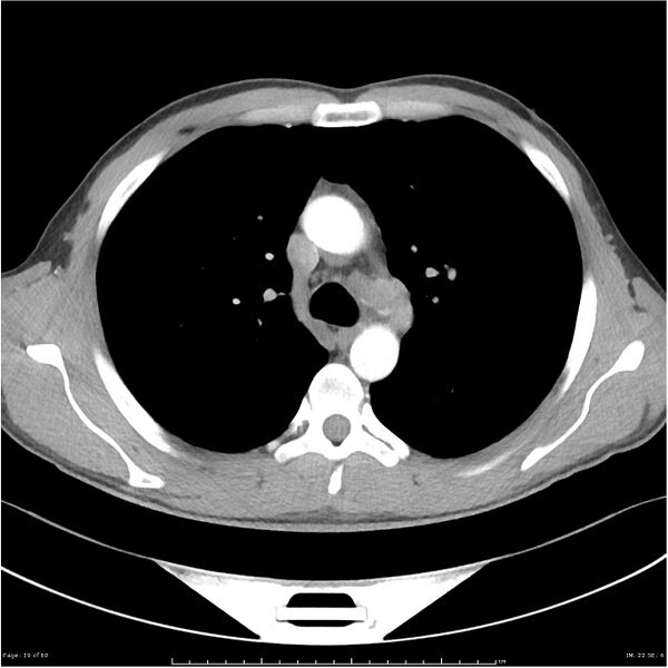 File:Cavitating lung cancer (Radiopaedia 25796-25945 C+ arterial phase 19).jpg
