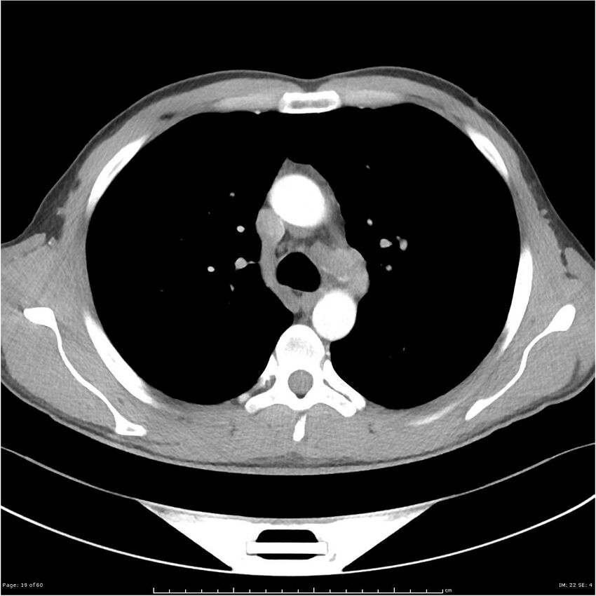 Cavitating lung cancer (Radiopaedia 25796-25945 C+ arterial phase 19).jpg