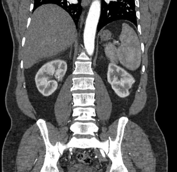 File:Celiac artery dissection (Radiopaedia 52194-58080 C 107).jpg