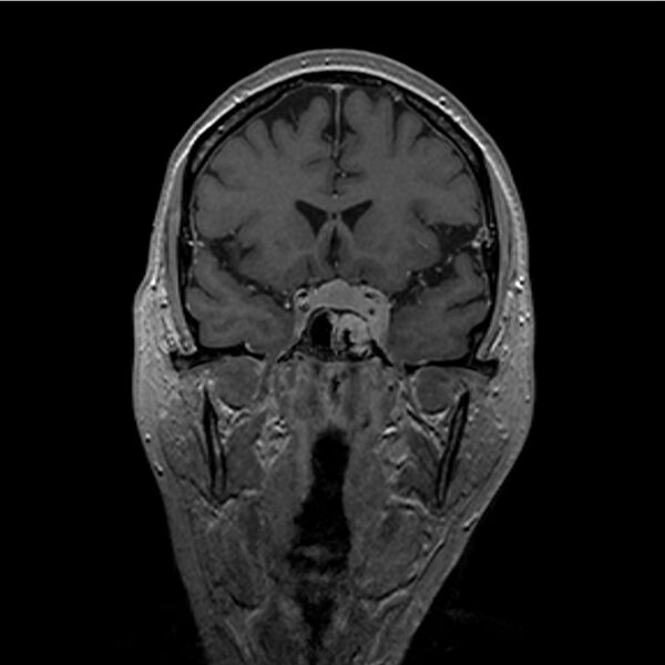 File:Central base of skull meningioma (Radiopaedia 53531-59549 Coronal T1 C+ 7).jpg