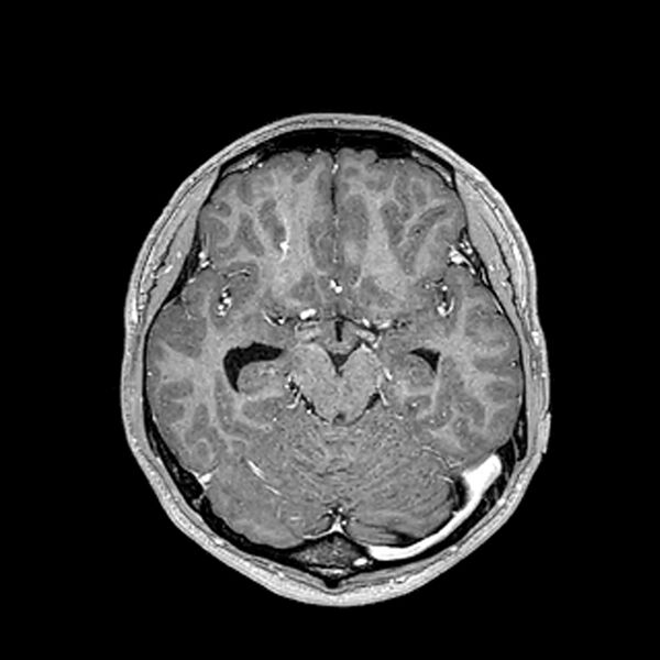 File:Central neurocytoma (Radiopaedia 79320-92380 Axial T1 C+ 103).jpg
