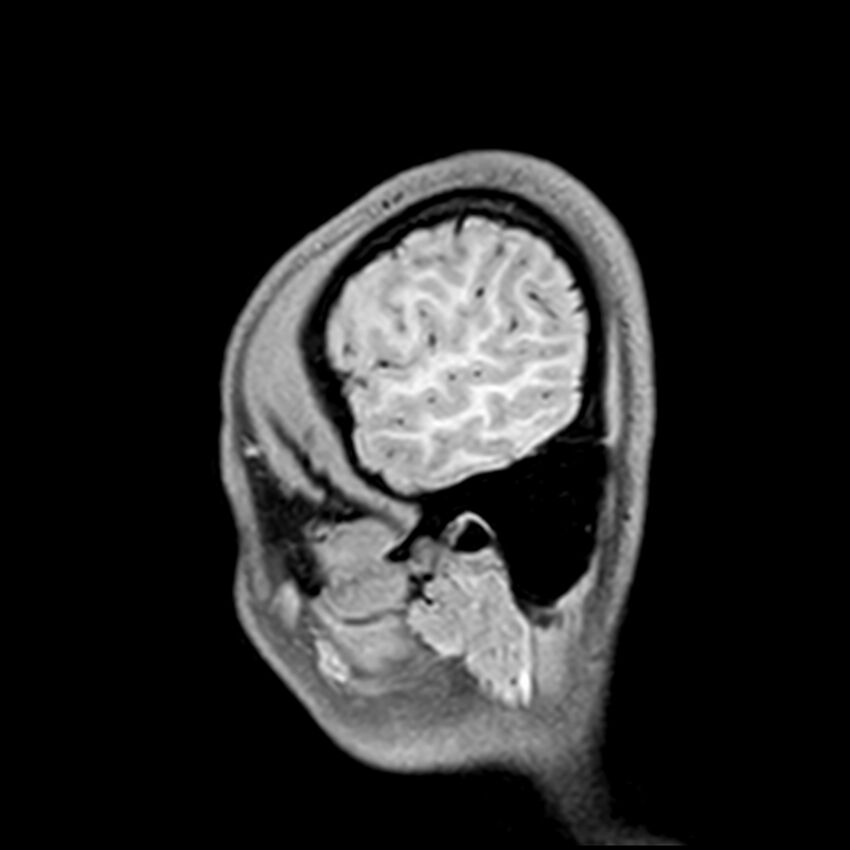 Central neurocytoma (Radiopaedia 79320-92380 Sagittal T1 230).jpg