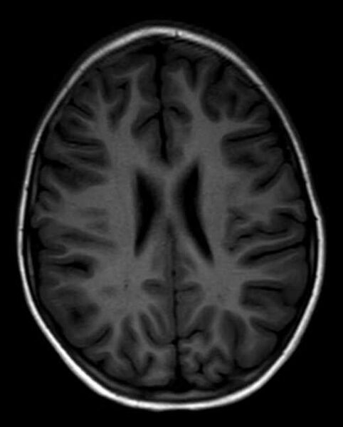 File:Cerebellar abscess (Radiopaedia 73727-84563 Axial T1 22).jpg