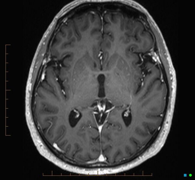 File:Cerebellar gangliocytoma (Radiopaedia 65377-74422 Axial T1 C+ 64).jpg
