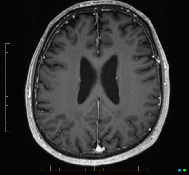 File:Cerebellar gangliocytoma (Radiopaedia 65377-74422 Axial T1 C+ 89).jpg