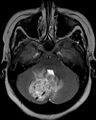 Cerebellar hemangioblastoma (Radiopaedia 10779-11234 Axial T2 1).JPG