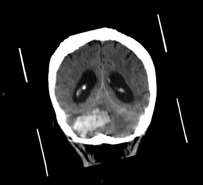 File:Cerebellar hemorrhage (Radiopaedia 58792-66026 Coronal non-contrast 23).jpg
