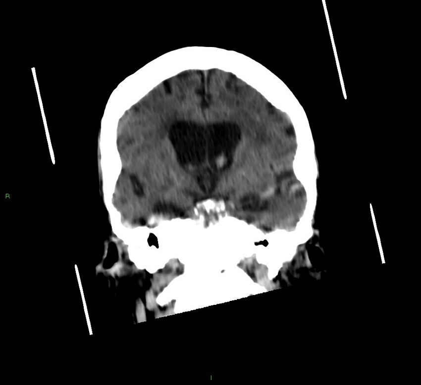 Cerebellar hemorrhage (Radiopaedia 58792-66026 Coronal non-contrast 37).jpg