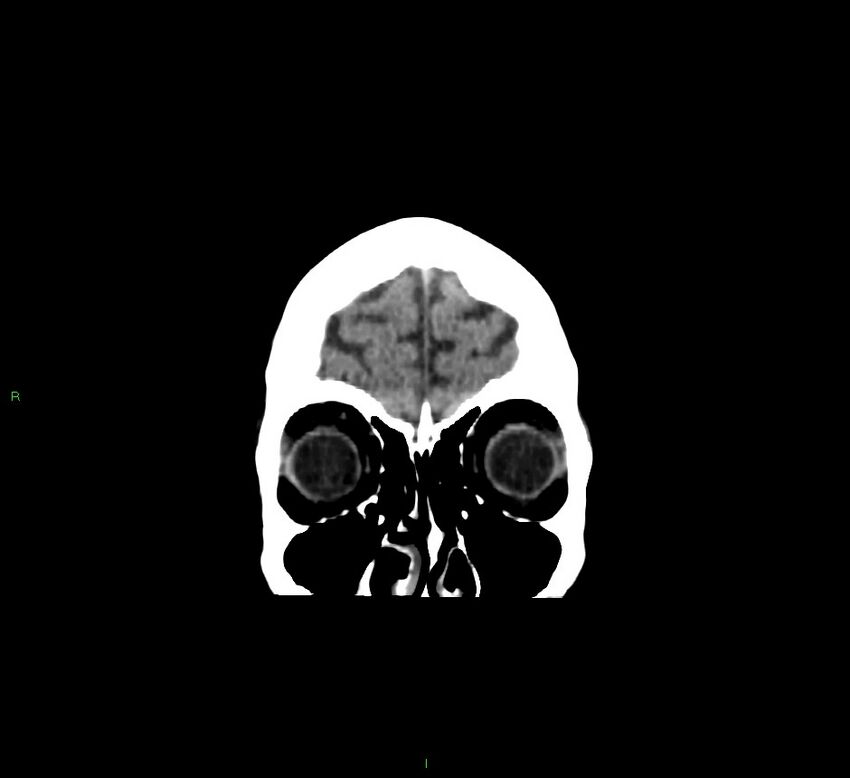 Cerebellar hemorrhage (Radiopaedia 58793-66027 Coronal non-contrast 58).jpg