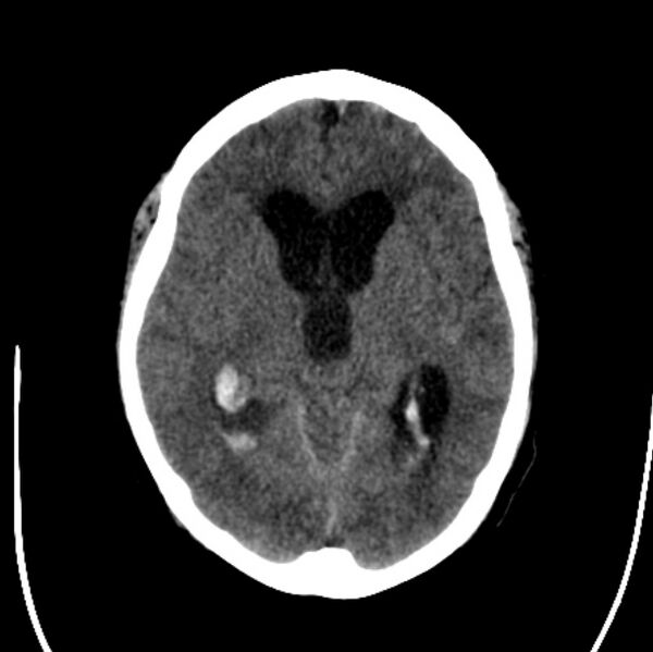 File:Cerebellar hemorrhage causing obstructive hydrocephalus (Radiopaedia 33989-35207 Axial non-contrast 24).jpg