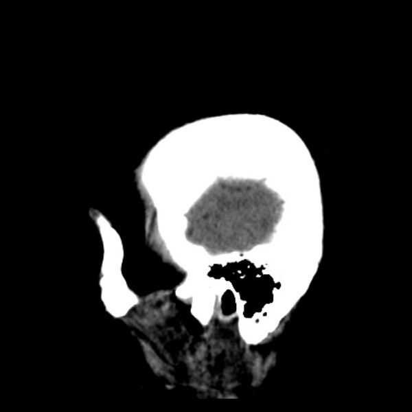File:Cerebellar hemorrhage causing obstructive hydrocephalus (Radiopaedia 33989-35207 B 42).jpg