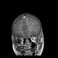 Cerebral abscess post cardiac surgery (Radiopaedia 27244-27420 Coronal T1 C+ 3).jpg