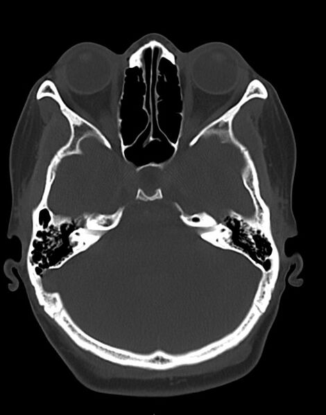 File:Cerebral abscesses (Radiopaedia 70458-80568 Axial bone window 19).jpg