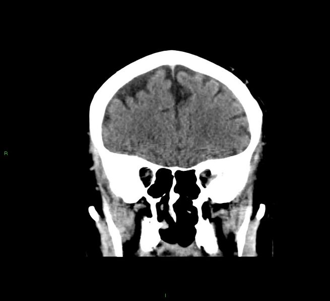File:Cerebral amyloid angiopathy-associated lobar intracerebral hemorrhage (Radiopaedia 58376-65511 Coronal non-contrast 48).jpg
