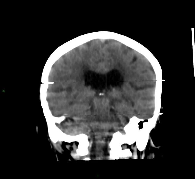 File:Cerebral amyloid angiopathy-associated lobar intracerebral hemorrhage (Radiopaedia 58377-65514 Coronal non-contrast 28).jpg